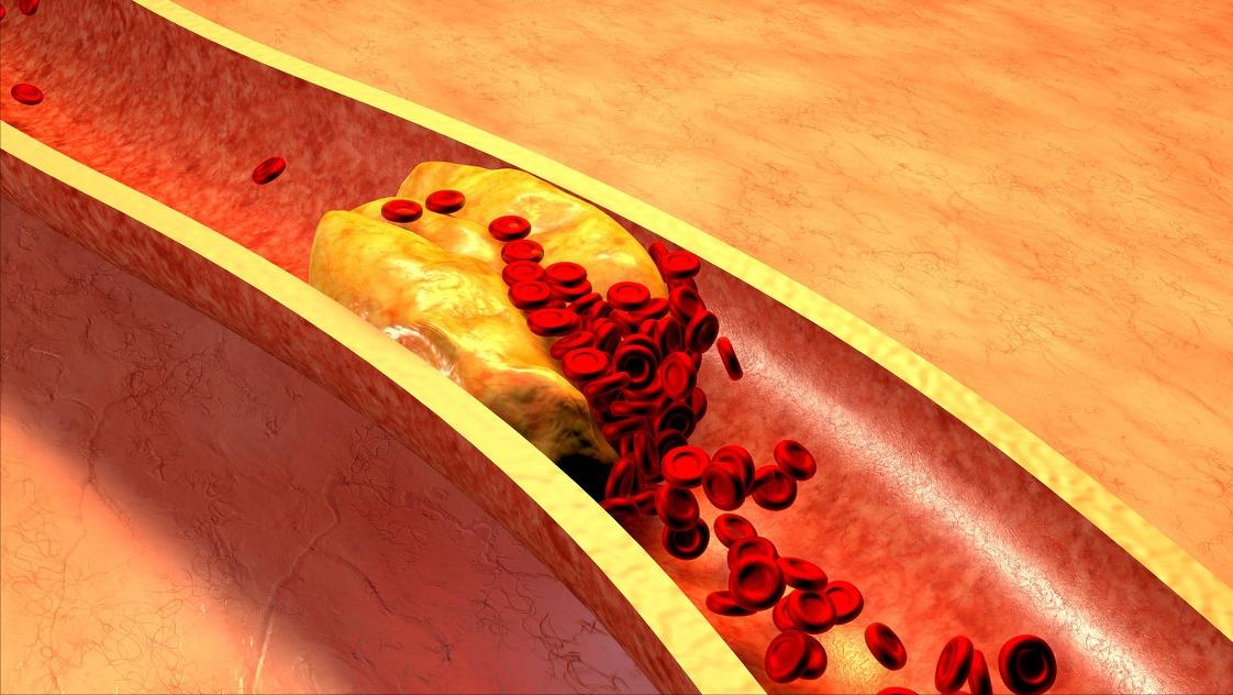 每天吃20个鸡蛋心梗,浙大教授研究癌症