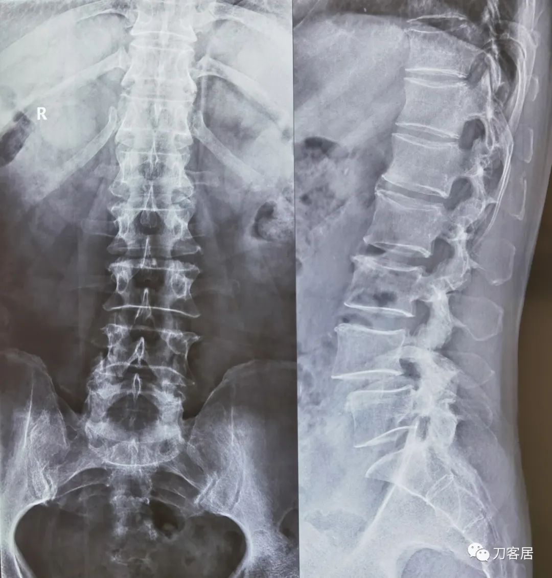 双小腿憋胀麻木,一般腰椎滑脱手术需要卧床多久