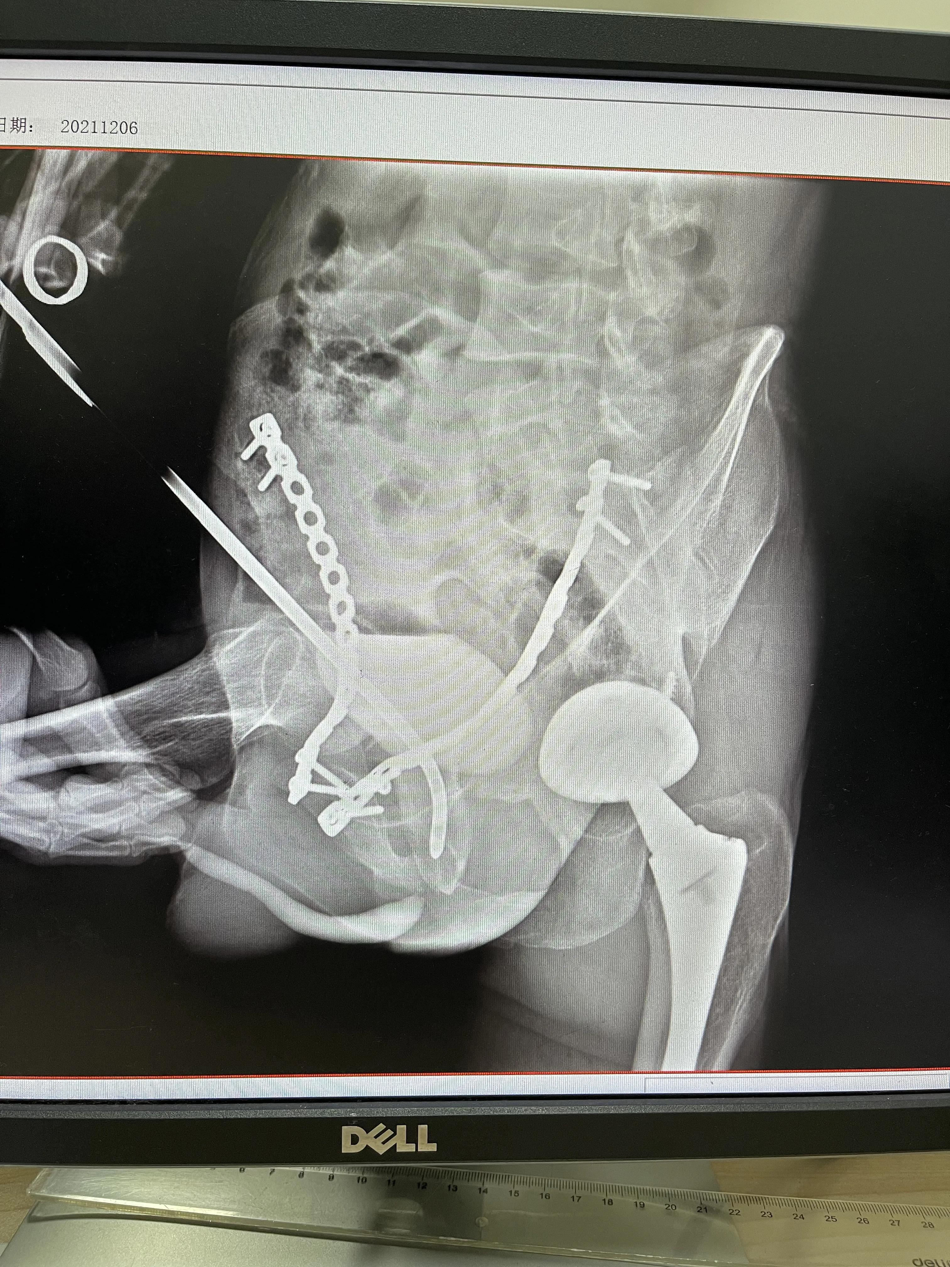 名医札记（113）“套筒穿刺导航法”治愈四川甘孜州膜部尿道闭锁
