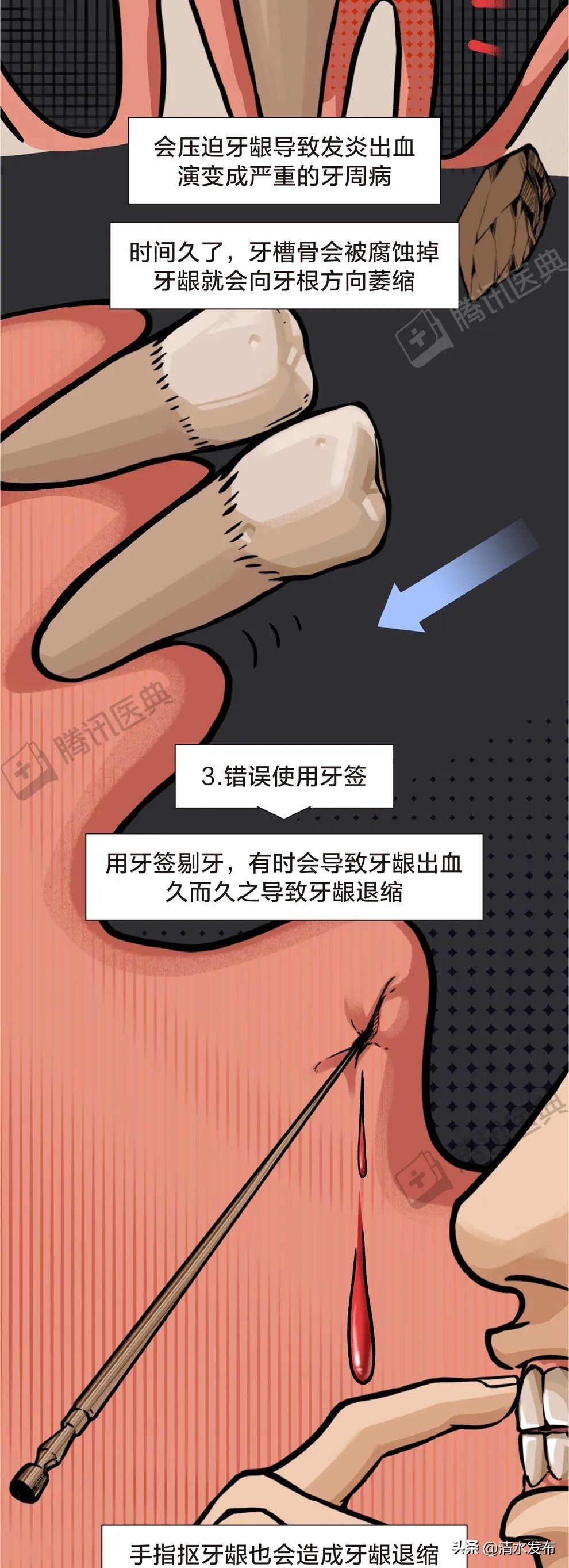 两边大牙一吃肉就塞牙如何修复,14岁学生吃肉老是塞牙需要矫正吗