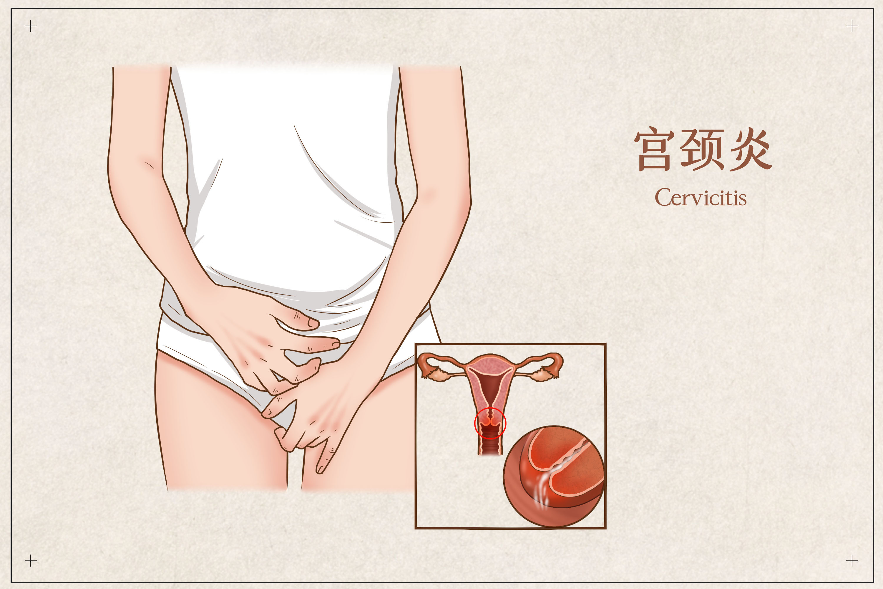 宫颈炎可以自己自愈吗,宫颈炎为什么会引起不孕不育