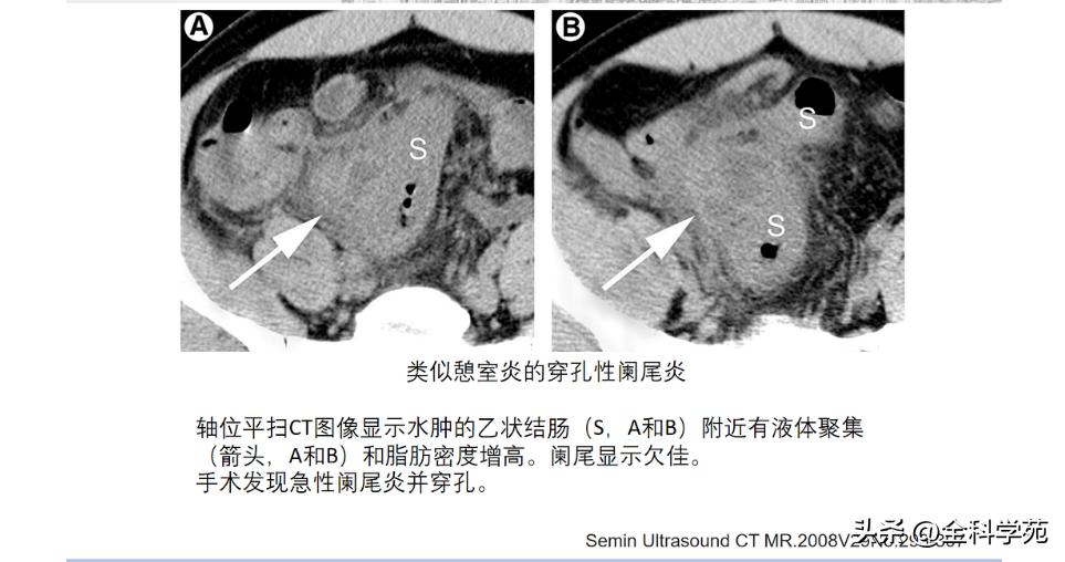 阑尾炎的讲解,关于阑尾炎的讨论总结