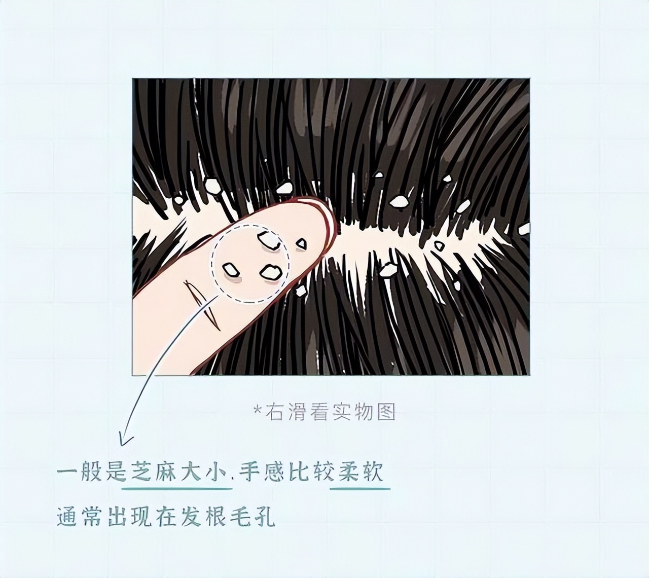 头皮上白色的颗粒是什么问题,头皮屑多是什么原因漫画