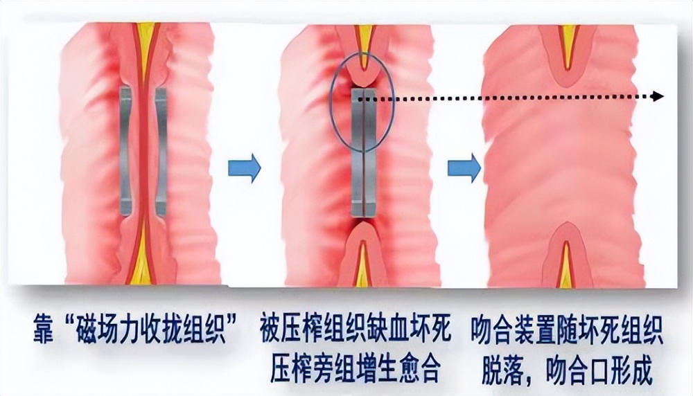 “小磁环”巧解大难题西安交大一附院应用S形磁环治疗直肠狭窄