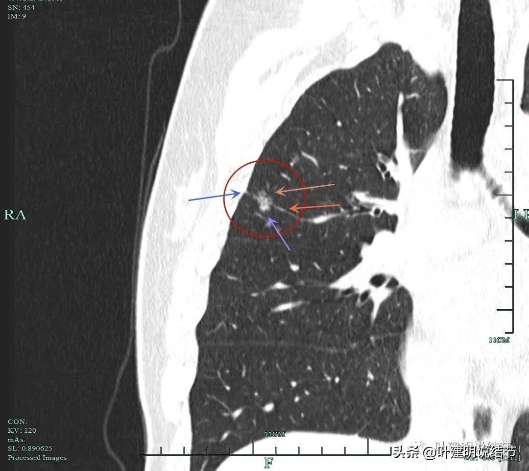 磨玻璃结节伴有增生是癌症吗,磨玻璃结节会是别的癌转移的吗