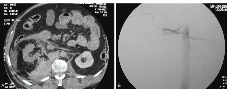 钝性闭合性肾损伤的诊治策略