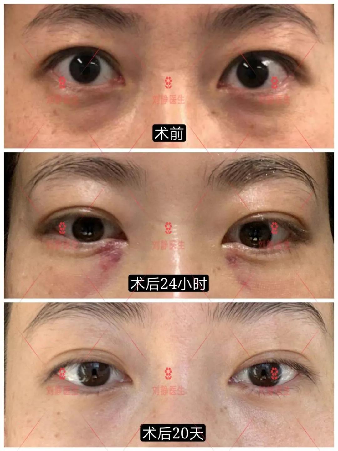 如何消除眼袋纹,如何消除眼袋最有效的方法男