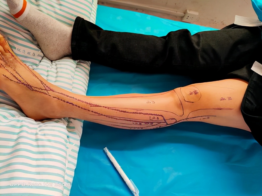 腓总神经卡压综合征点穴按摩,腓总神经卡压综合征