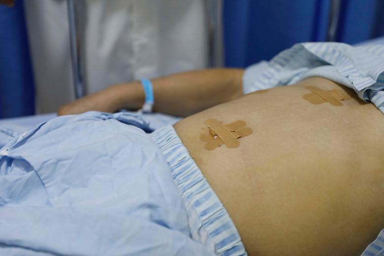 超级微创保胆取石,双镜联合超微创保胆取石手术