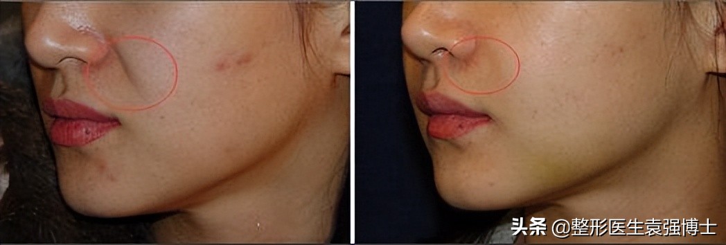 有什么办法能解决法令纹,有法令纹最好的解决办法真实有效