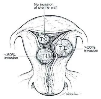 妇科专家教你认识宫腔镜,宫腔镜妇科主任