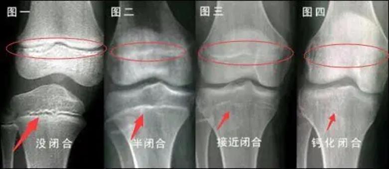 孩子出现哪些症状证明要长高了,出现这四种情况说明孩子长高了