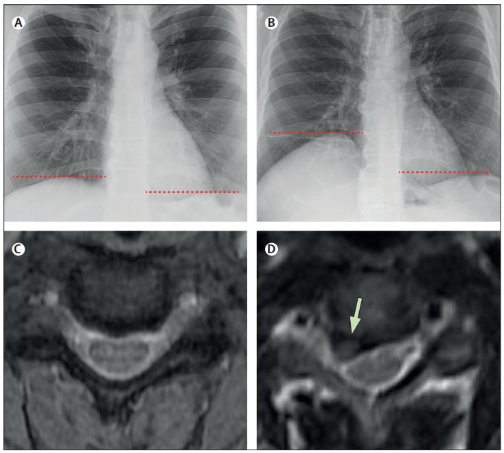 颈椎病导致胸痛呼吸困难,颈椎病会引起胸疼呼吸困难吗