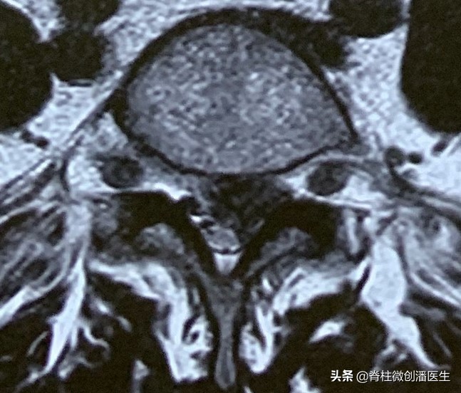 腰椎间盘4到5突出不手术会全好吗,70岁老人腰椎间盘突出适合手术吗
