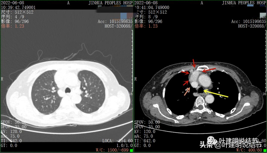 这位老乡，乏力来查，查出这么大个的纵隔肿瘤！会是什么呢？
