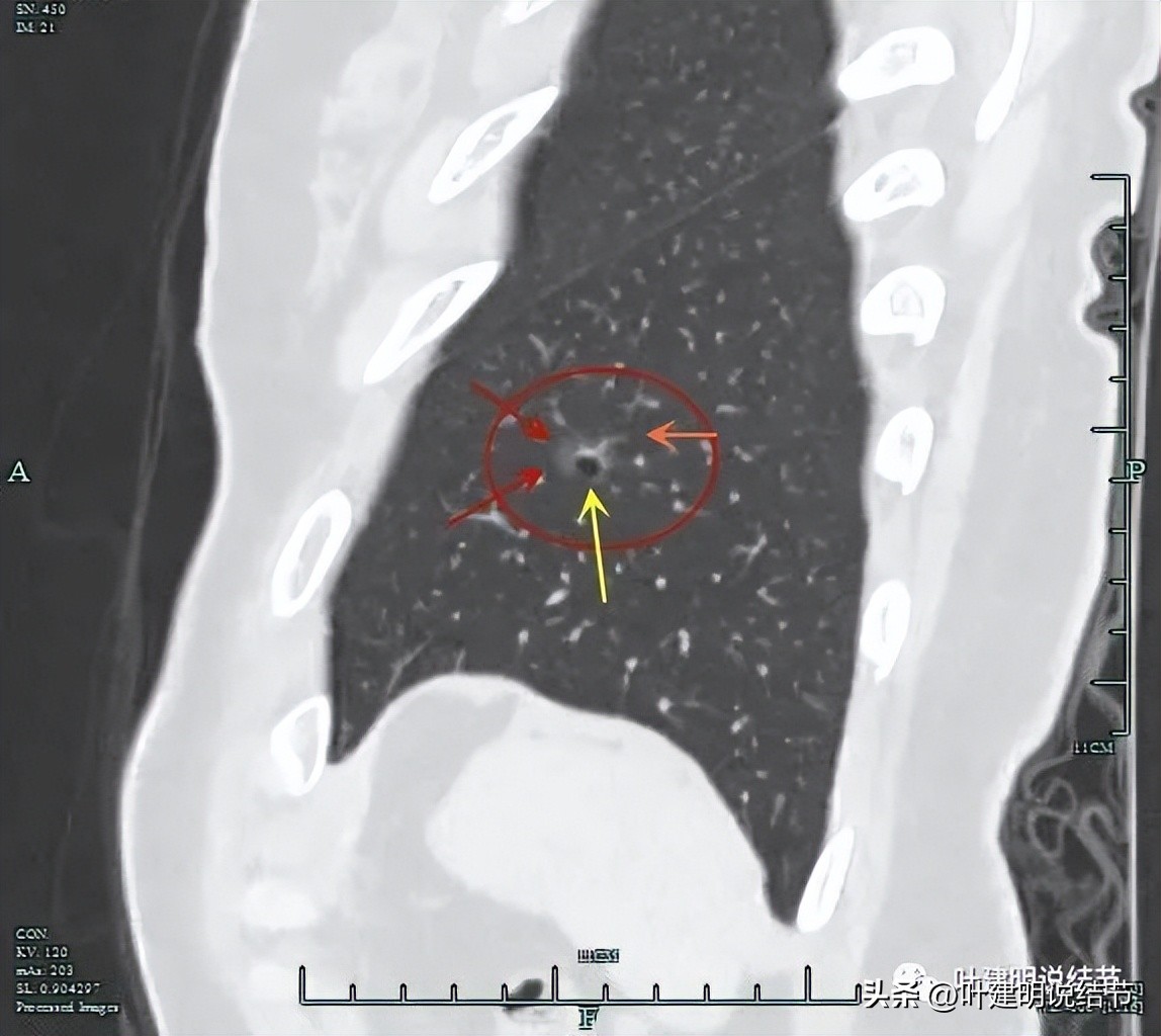 辽宁省肺结节手术哪家医院好,辽宁肺结节手术医院