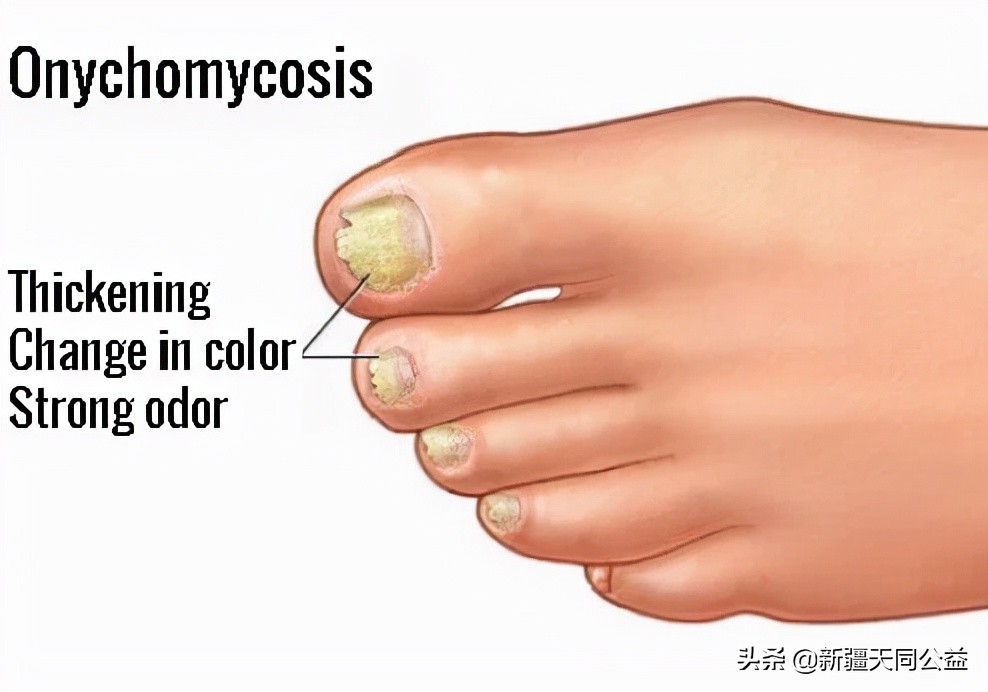 感染艾滋病指甲的变化,艾滋病初期指甲有什么变化