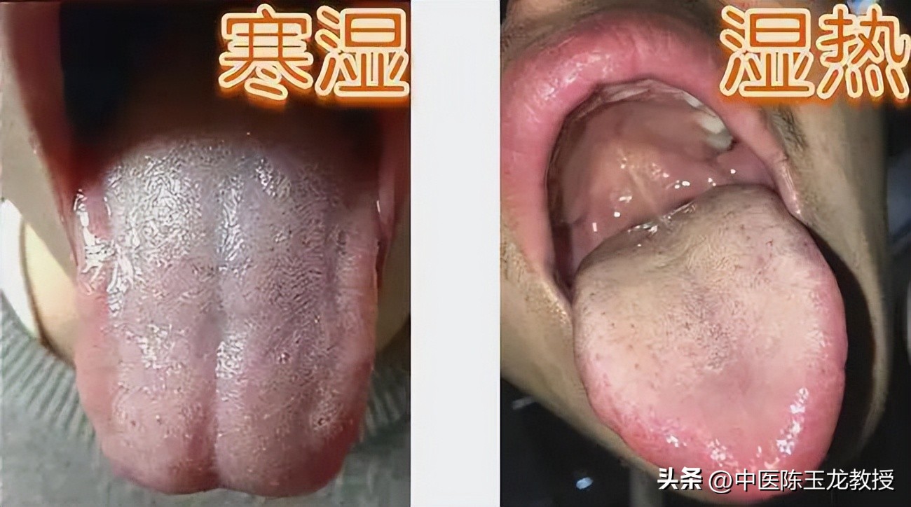 滤泡性咽喉炎中药方子,咽喉炎扁桃体炎常用中药