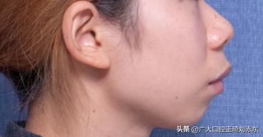 嘴凸要做正畸还是正颌,嘴凸下巴后缩应该正畸还是正颌