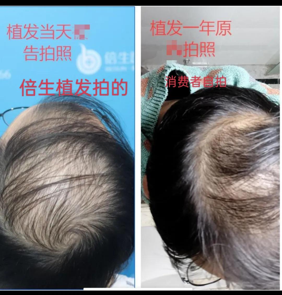 天生发际线高植发长久靠谱吗,发际线高植发一年的效果