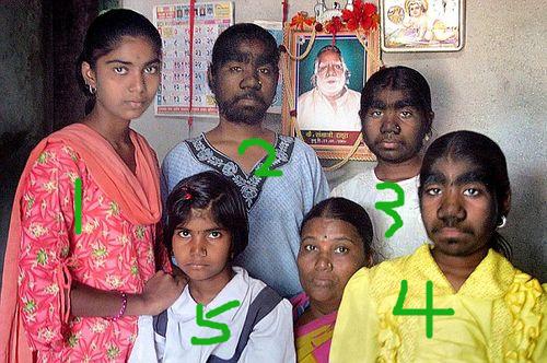 故事:非洲17岁女孩长满络腮胡,毛发从鼻孔长到脖子,身体有何异常