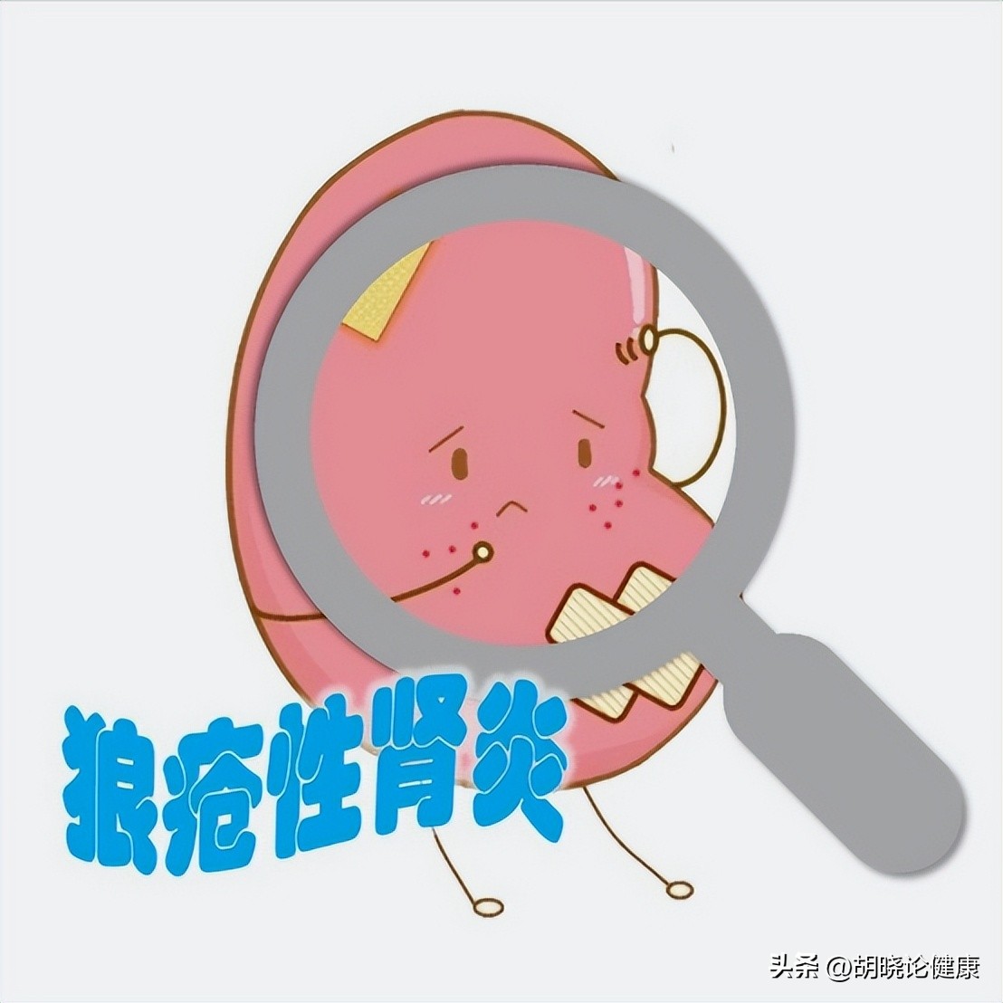 狼疮肾炎补体c4低是狼疮复发吗,狼疮性肾炎诊断的特异性抗体指标