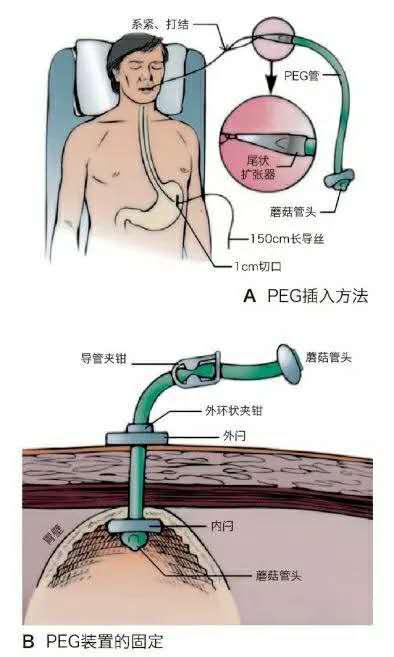 经皮胃镜下胃造瘘术操作步骤,什么是经皮内镜下胃造瘘