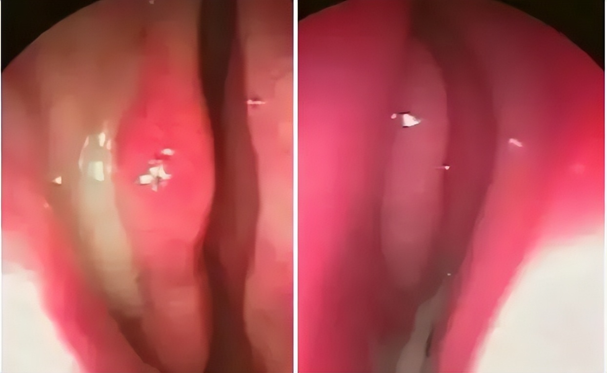 1秒通鼻！10年老鼻炎有救了，终于可以正常呼吸了