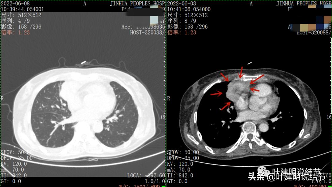 这位老乡，乏力来查，查出这么大个的纵隔肿瘤！会是什么呢？