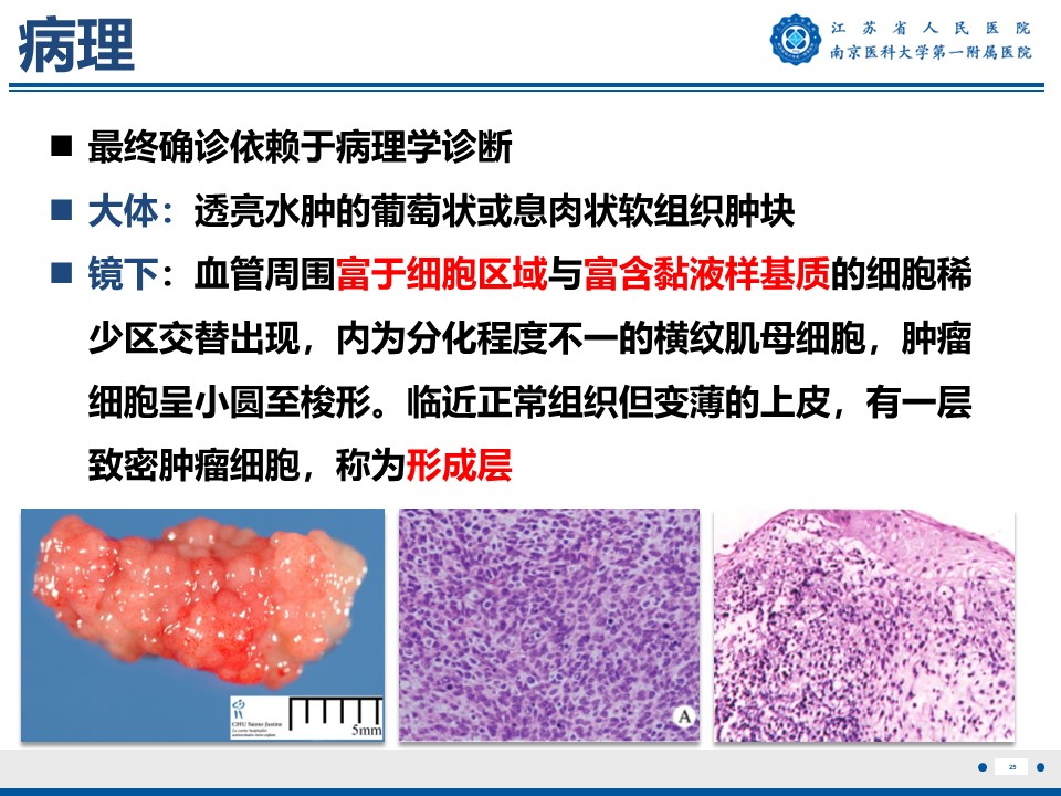 好文分享——《胚胎型横纹肌肉瘤》
