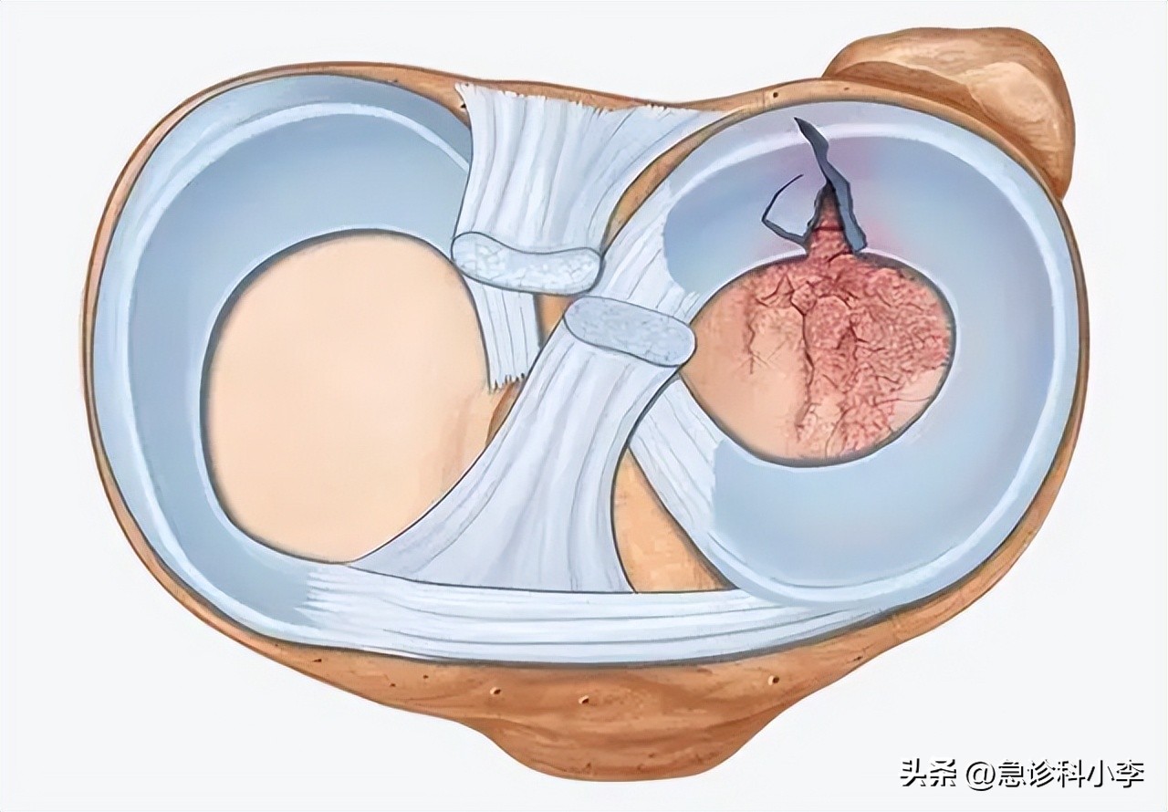 老人家膝盖半月板疼痛的治疗方法,65岁老人半月板损伤膝盖痛