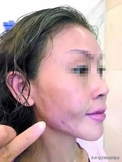 吸脂会皮肤松,吸脂太多可以脂肪填充补回来吗