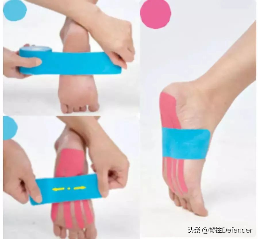 足跟痛筋膜炎最佳的治疗方法,足跟痛和足底筋膜炎康复治疗