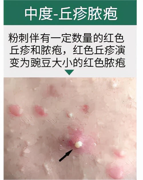 青春痘变疮了要怎么治,治脓包型青春痘偏方