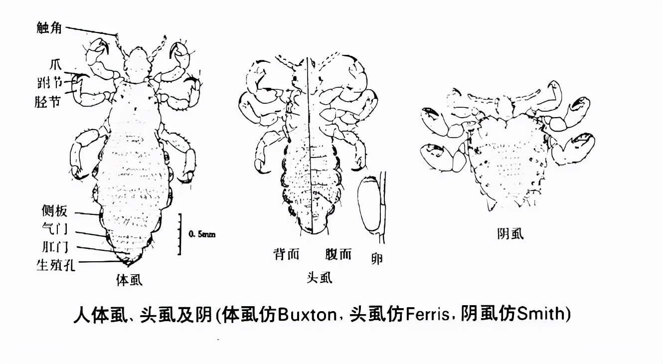 30年前人人都有虱子为啥现在消失,20年前的虱子为什么消失了科普