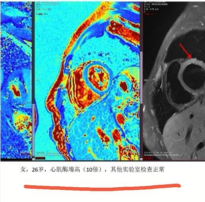 女子阳后确诊心肌炎,阳了后心肌炎6个征兆