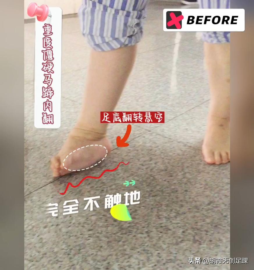 马蹄内翻足矫正后遗症,30岁严重的马蹄内翻足矫正