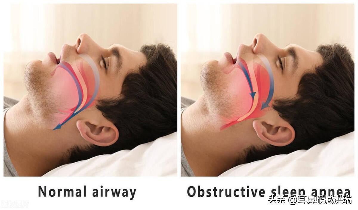 从医生的角度分析，鼻息肉的危害有哪些？