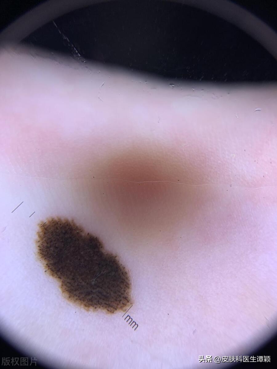 什么样的色素痣要去掉,什么样的色素痣要去除