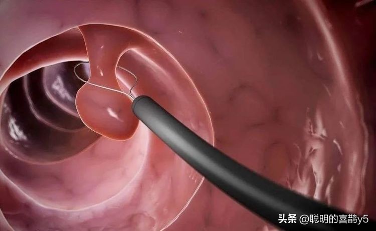 子宫里长息肉切除之后能怀孕吗,绝经后子宫息肉如果切除会复发吗