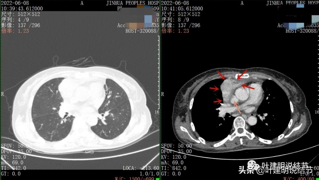 这位老乡，乏力来查，查出这么大个的纵隔肿瘤！会是什么呢？