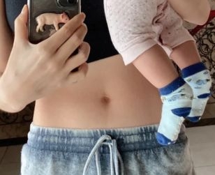 产后如何淡化妊娠纹一个妙招,产后淡化妊娠纹最有效的方法