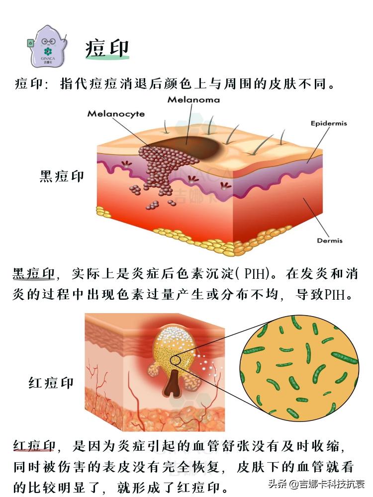 如何祛痘的方法最有效,怎样祛痘最快最有效10个小方法
