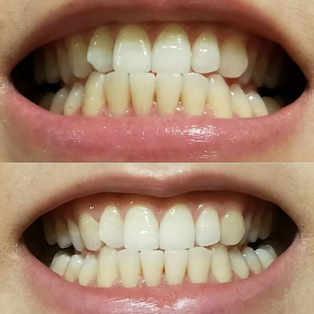 快速去牙渍牙垢牙黄的神器,牙黄牙渍怎么刷掉小妙招