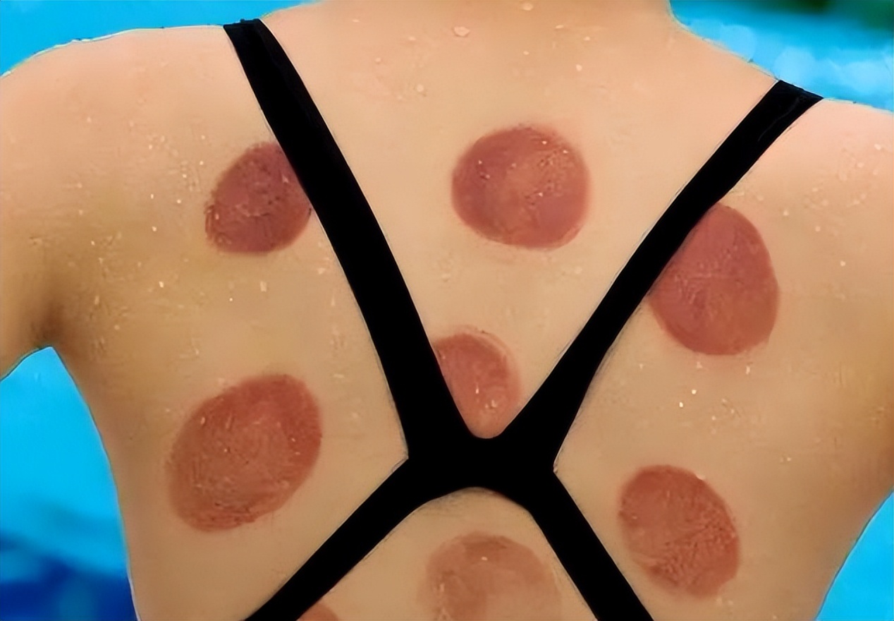 拔火罐出现的瘀血，是体内的毒素吗？