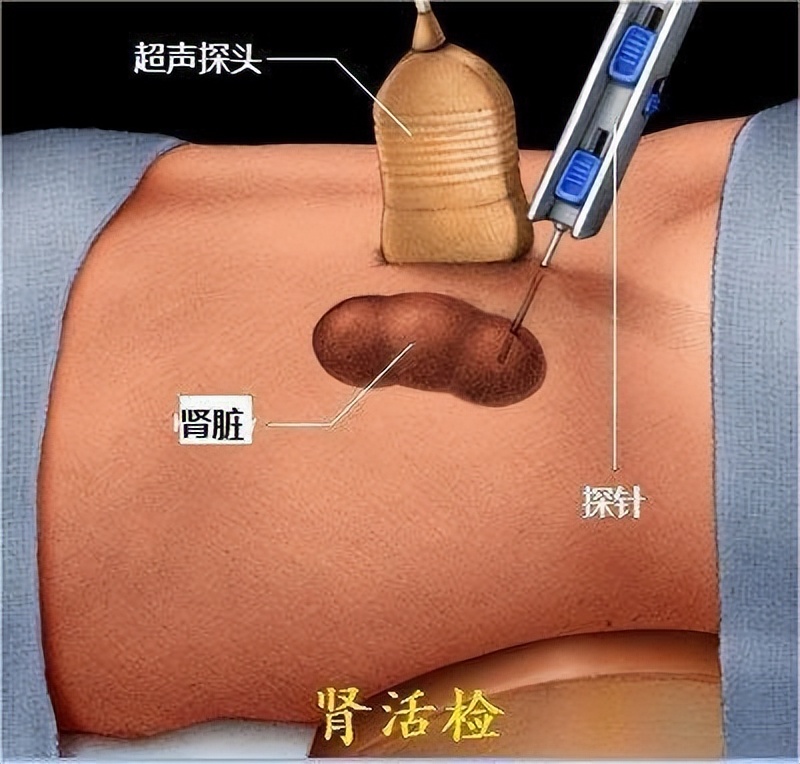 北大医院太原医院成功开展一例孤立肾活检穿刺术