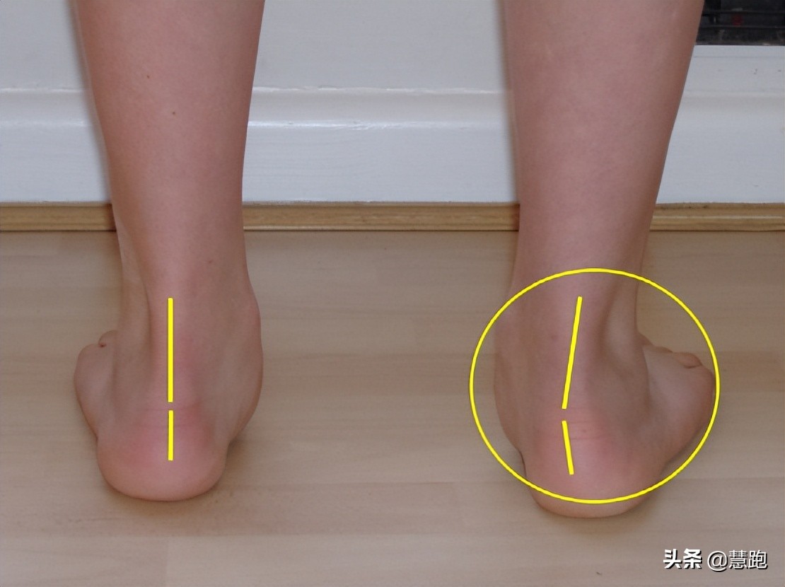 足底筋膜炎久治不愈怎么办,为什么足筋膜炎久治不愈