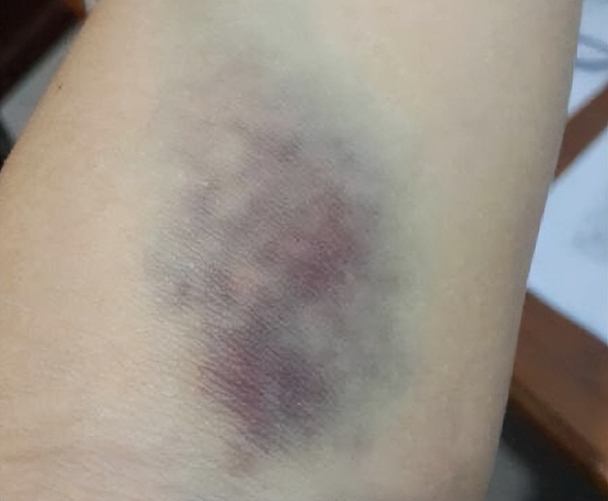 筋膜枪按摩时间长的危害,女性用筋膜枪的危害