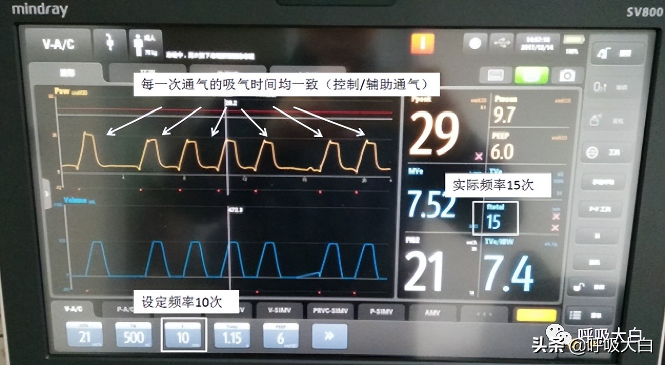 呼吸机设置：呼吸频率+吸呼比