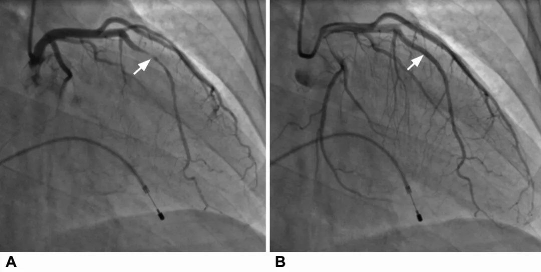 发现浅表性心肌桥多久复查,心肌桥最新发现